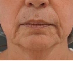 Sofwave Before & After Patient #1603